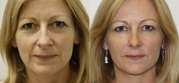 Facial Fillers Treatment at Competitive Prices