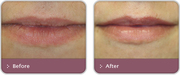 Lip Enhancement Treatment Nottingham at Yourderma